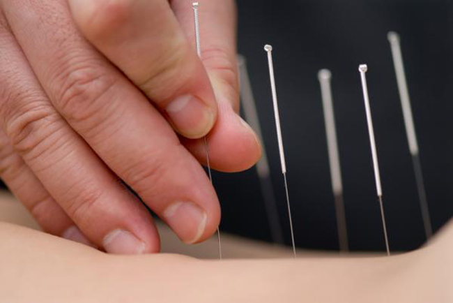 Unlocking the Ancient Healing Power of Acupuncture